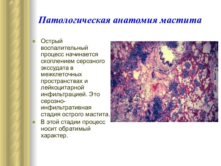 Патологическая анатомия мастита Острый воспалительный процесс начинается скоплением серозного экссудата