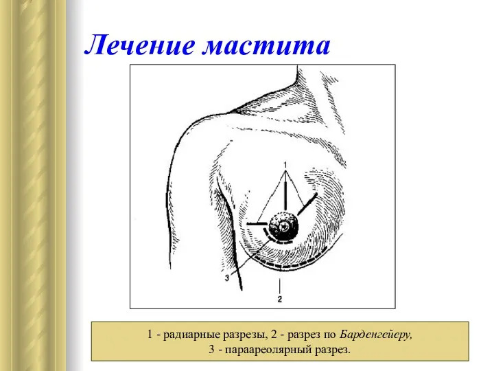 Лечение мастита 1 - радиарные разрезы, 2 - разрез по Барденгейеру, 3 - параареолярный разрез.