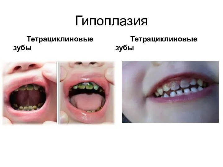 Гипоплазия Тетрациклиновые зубы Тетрациклиновые зубы