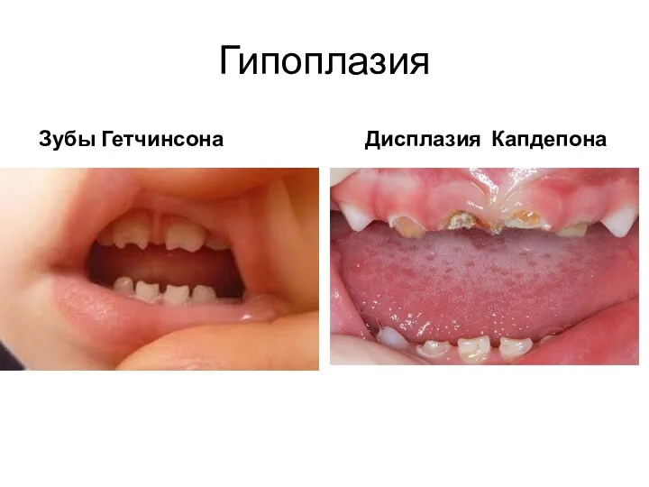 Гипоплазия Зубы Гетчинсона Дисплазия Капдепона