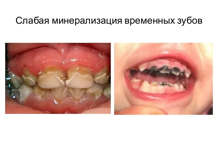 Слабая минерализация временных зубов