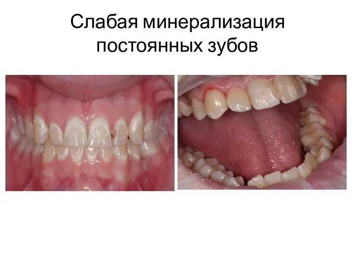 Слабая минерализация постоянных зубов