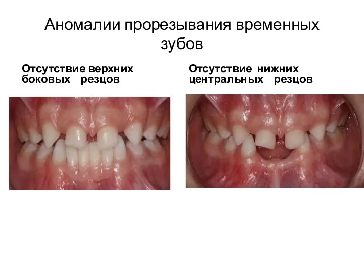 Аномалии прорезывания временных зубов Отсутствие верхних боковых резцов Отсутствие нижних центральных резцов