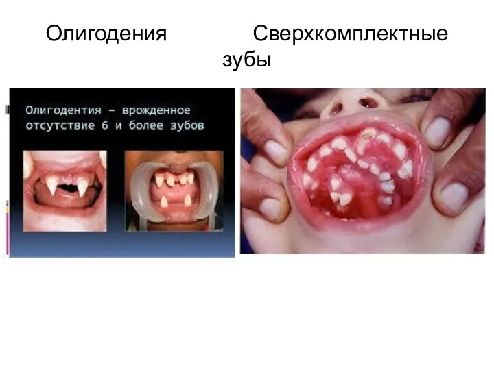 Олигодения Сверхкомплектные зубы