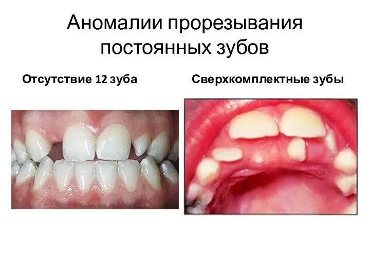 Аномалии прорезывания постоянных зубов Отсутствие 12 зуба Сверхкомплектные зубы