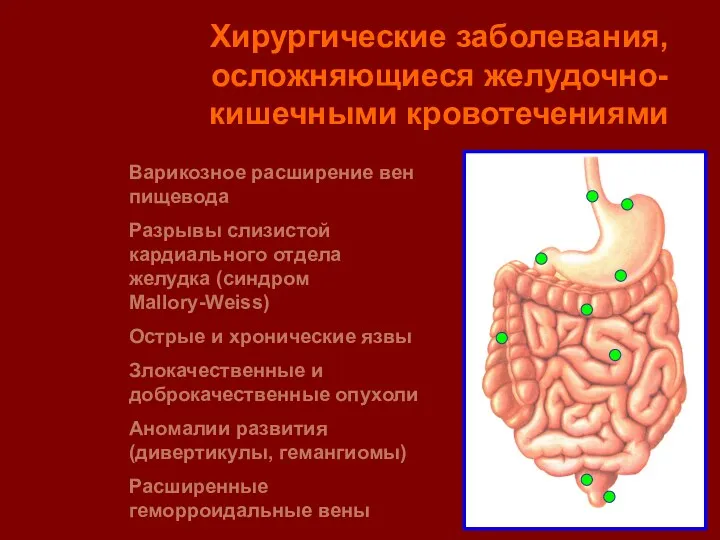 Хирургические заболевания, осложняющиеся желудочно-кишечными кровотечениями Варикозное расширение вен пищевода Разрывы