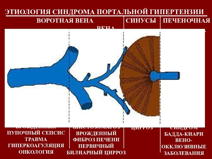 ЭТИОЛОГИЯ СИНДРОМА ПОРТАЛЬНОЙ ГИПЕРТЕНЗИИ ВОРОТНАЯ ВЕНА СИНУСЫ ПЕЧЕНОЧНАЯ ВЕНА ВНЕПЕЧЕНОЧНЫЕ