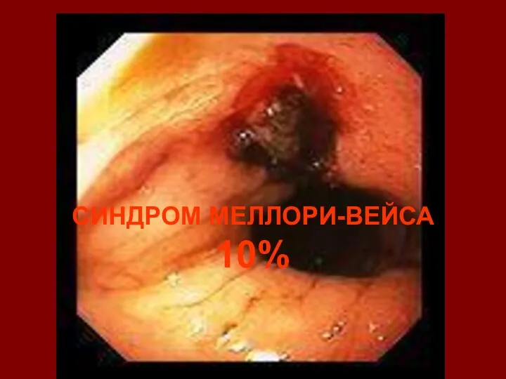 СИНДРОМ МЕЛЛОРИ-ВЕЙСА 10%