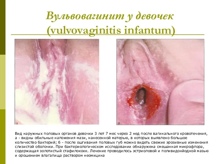 Вульвовагинит у девочек (vulvovaginitis infantum) Вид наружных половых органов девочки