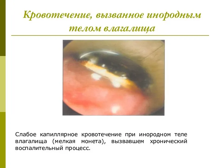 Кровотечение, вызванное инородным телом влагалища Слабое капиллярное кровотечение при инородном