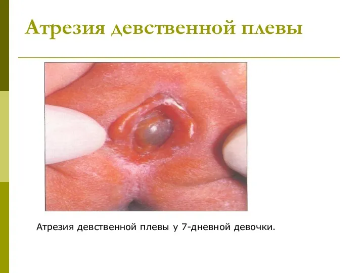 Атрезия девственной плевы Атрезия девственной плевы у 7-дневной девочки.