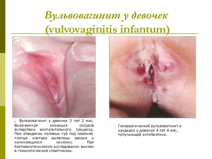 Вульвовагинит у девочек (vulvovaginitis infantum) . Вульвовагинит у девочки 3