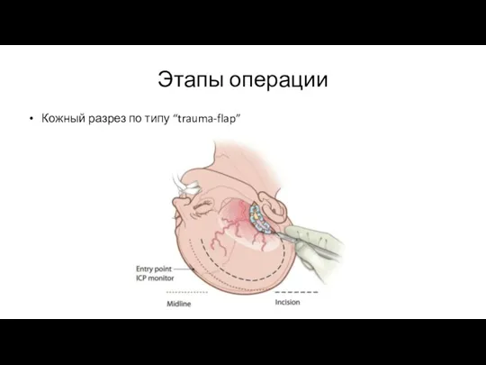Этапы операции Кожный разрез по типу “trauma-flap”