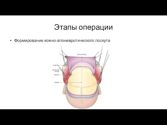 Этапы операции Формирование кожно-апоневротического лоскута