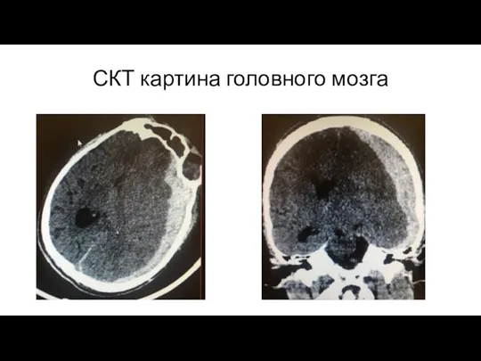 СКТ картина головного мозга