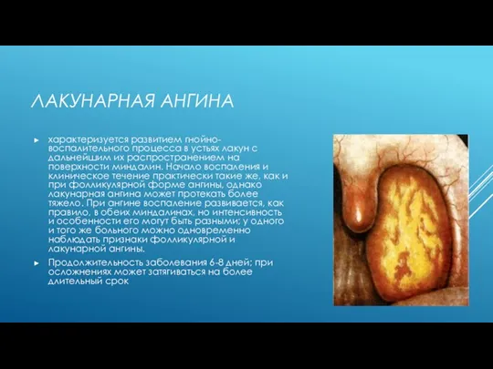ЛАКУНАРНАЯ АНГИНА характеризуется развитием гнойно-воспалительного процесса в устьях лакун с