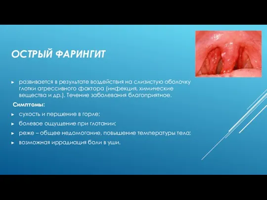 ОСТРЫЙ ФАРИНГИТ развивается в результате воздействия на слизистую оболочку глотки