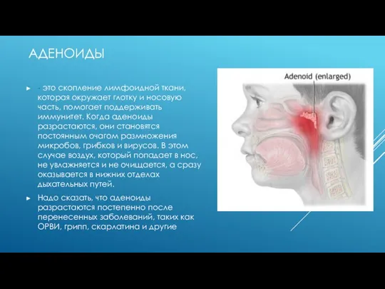АДЕНОИДЫ - это скопление лимфоидной ткани, которая окружает глотку и