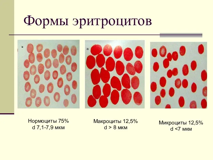 Формы эритроцитов Нормоциты 75% d 7,1-7,9 мкм Макроциты 12,5% d > 8 мкм Микроциты 12,5% d
