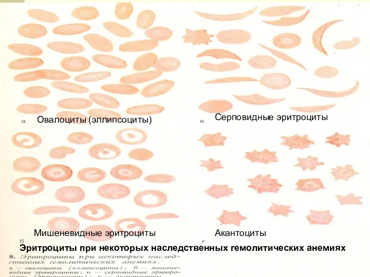 Серповидные эритроциты Овалоциты (эллипсоциты) Мишеневидные эритроциты Акантоциты Эритроциты при некоторых наследственных гемолитических анемиях