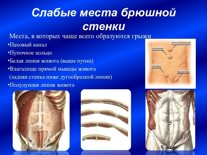 Слабые места брюшной стенки Места, в которых чаще всего образуются