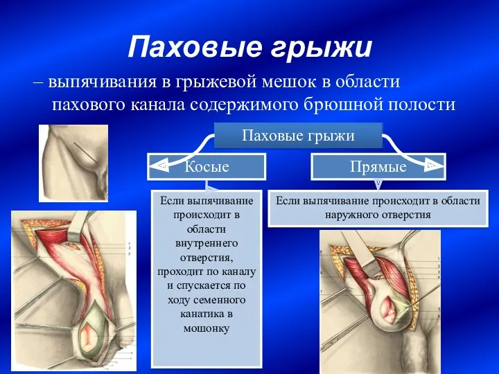 Паховые грыжи – выпячивания в грыжевой мешок в области пахового