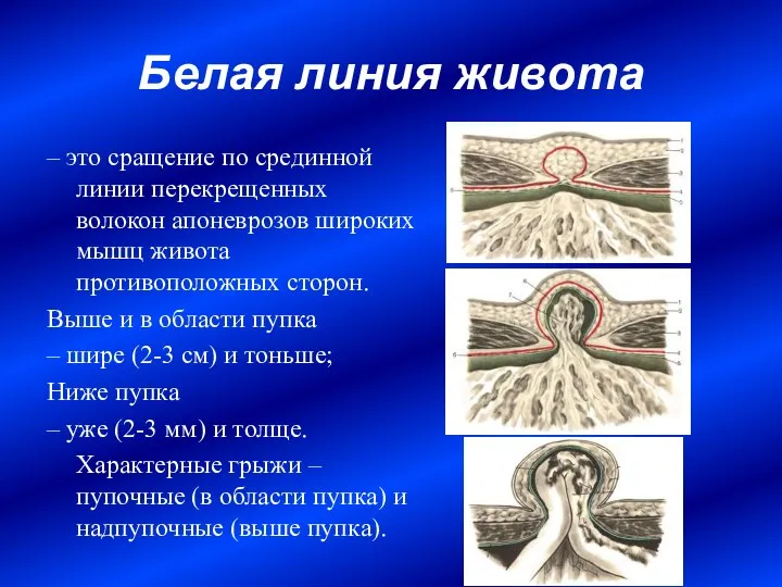 Белая линия живота – это сращение по срединной линии перекрещенных