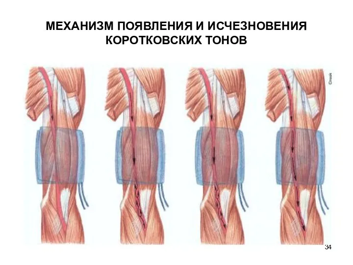 МЕХАНИЗМ ПОЯВЛЕНИЯ И ИСЧЕЗНОВЕНИЯ КОРОТКОВСКИХ ТОНОВ