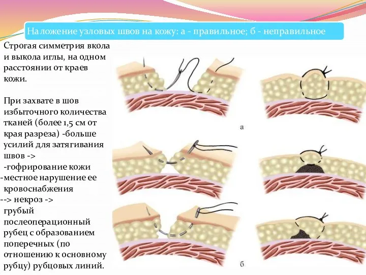 Строгая симметрия вкола и выкола иглы, на одном расстоянии от