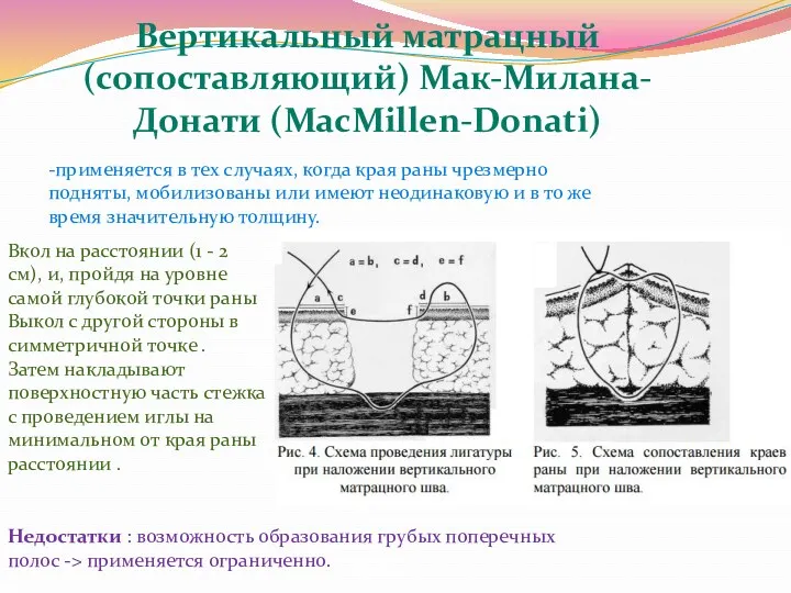 -применяется в тех случаях, когда края раны чрезмерно подняты, мобилизованы или имеют неодинаковую