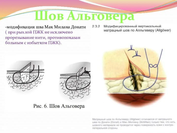 -модификация шва Мак Милана Донати ( при рыхлой ПЖК не исключено прорезывание нити,