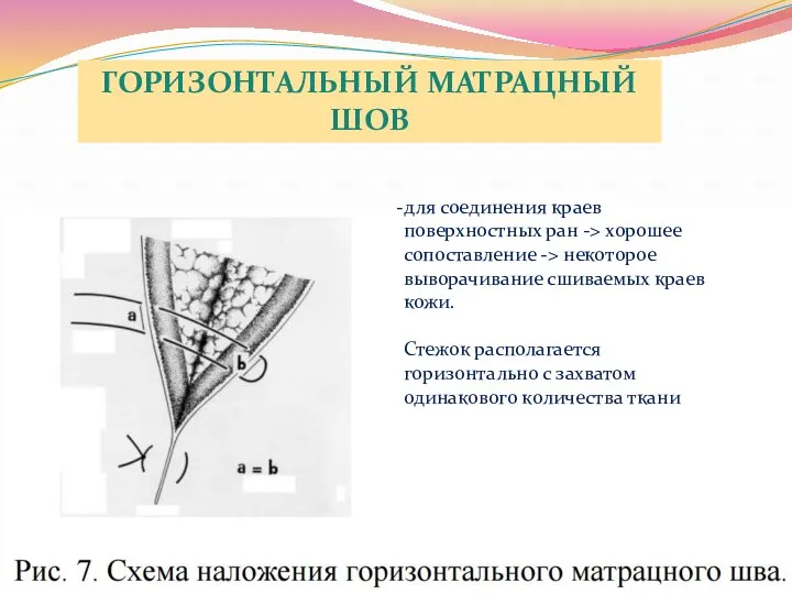 ГОРИЗОНТАЛЬНЫЙ МАТРАЦНЫЙ ШОВ для соединения краев поверхностных ран -> хорошее