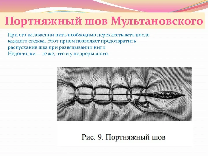 Портняжный шов Мультановского При его наложении нить необходимо перехлестывать после каждого стежка. Этот