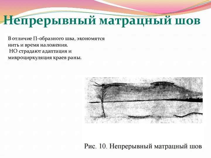 В отличие П-образного шва, экономятся нить и время наложения. НО