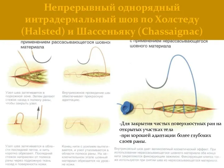 Непрерывный однорядный интрадермальный шов по Холстеду (Halsted) и Шассеньяку (Chassaignac) -Для закрытия чистых