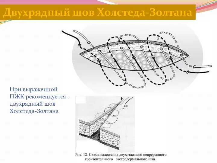 При выраженной ПЖК рекомендуется -двухрядный шов Холстеда-Золтана Двухрядный шов Холстеда-Золтана