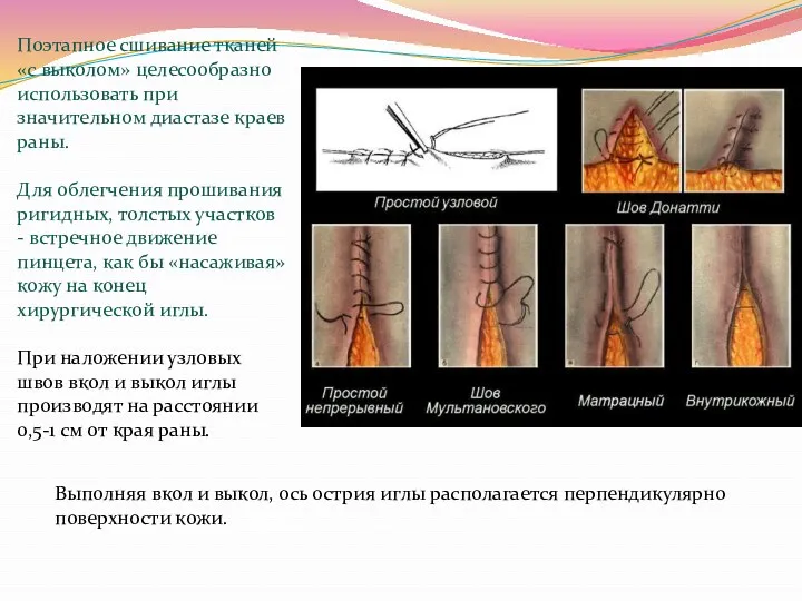 Поэтапное сшивание тканей «с выколом» целесообразно использовать при значительном диастазе краев раны. Для