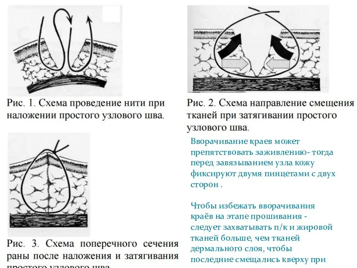 Вворачивание краев может препятствовать заживлению- тогда перед завязыванием узла кожу фиксируют двумя пинцетами