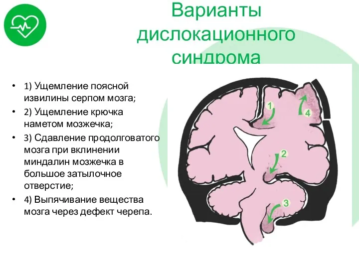Варианты дислокационного синдрома 1) Ущемление поясной извилины серпом мозга; 2)