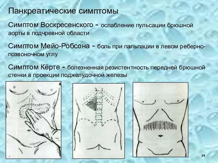 Панкреатические симптомы Симптом Воскресенского - ослабление пульсации брюшной аорты в