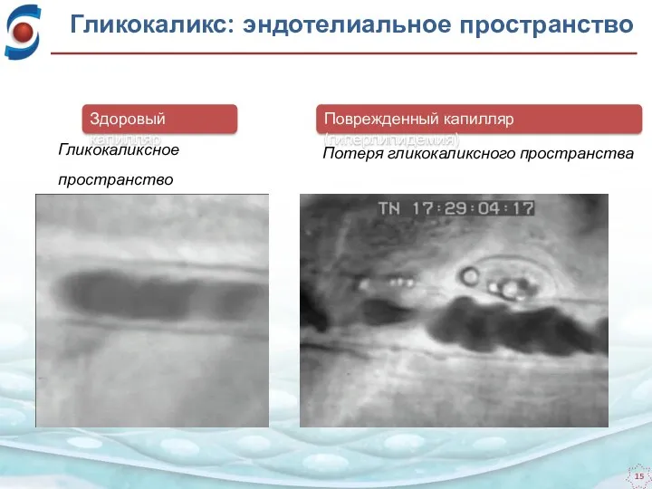 Гликокаликсное пространство Потеря гликокаликсного пространства Здоровый капилляр Поврежденный капилляр (гиперлипидемия) Гликокаликс: эндотелиальное пространство