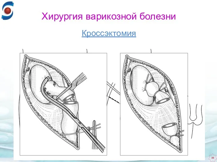 Кроссэктомия Хирургия варикозной болезни