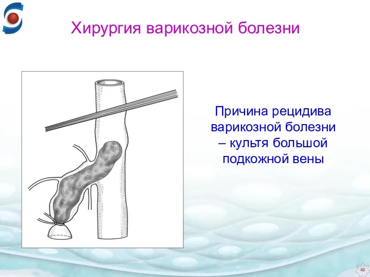 Причина рецидива варикозной болезни ‒ культя большой подкожной вены Хирургия варикозной болезни