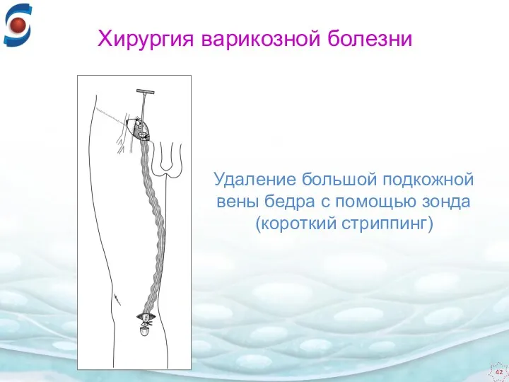 Удаление большой подкожной вены бедра с помощью зонда (короткий стриппинг) Хирургия варикозной болезни