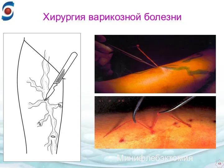 Минифлебэктомия Хирургия варикозной болезни