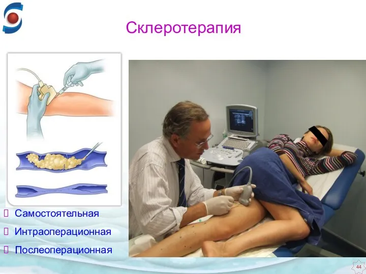 Самостоятельная Интраоперационная Послеоперационная Склеротерапия