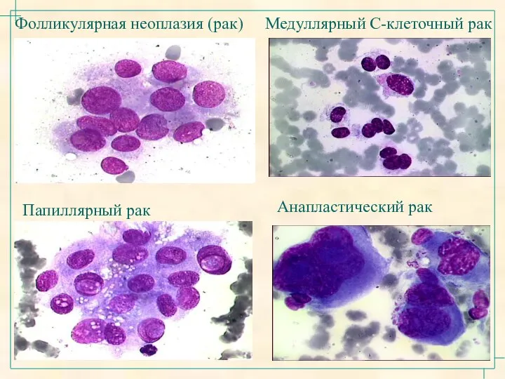 Фолликулярная неоплазия (рак) Папиллярный рак Медуллярный C-клеточный рак Анапластический рак