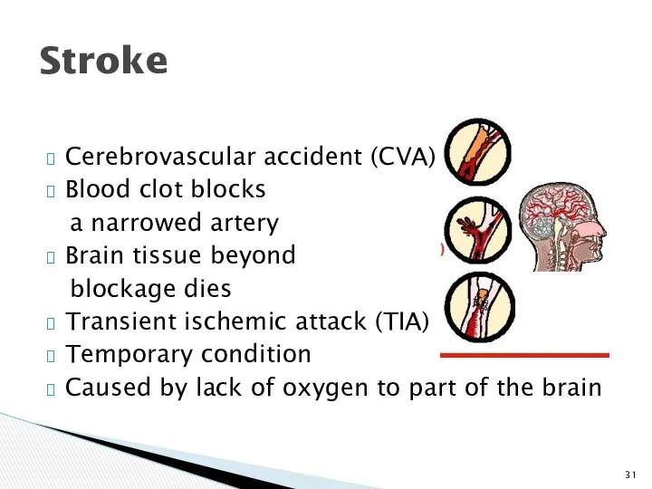 Cerebrovascular accident (CVA) Blood clot blocks a narrowed artery Brain tissue beyond blockage