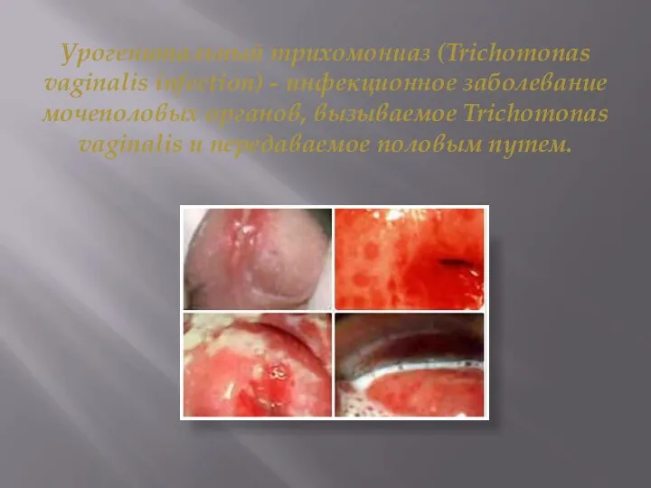 Урогенитальный трихомониаз (Trichomonas vaginalis infection) - инфекционное заболевание мочеполовых органов,