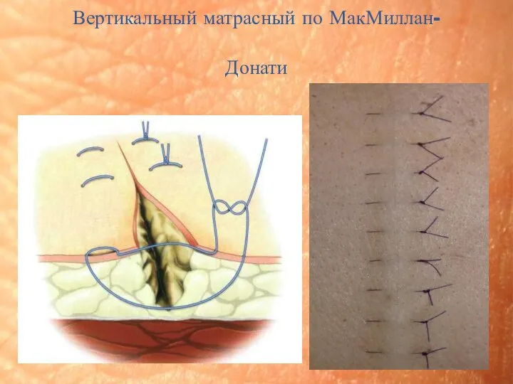 Вертикальный матрасный по МакМиллан-Донати